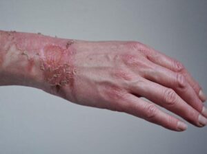 Acesso Biologics – Amniotic Tissue Allograft & Products