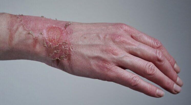 Acesso Biologics – Amniotic Tissue Allog...
