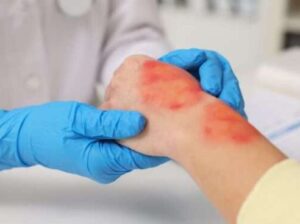 Acesso Biologics – Amniotic Tissue Products